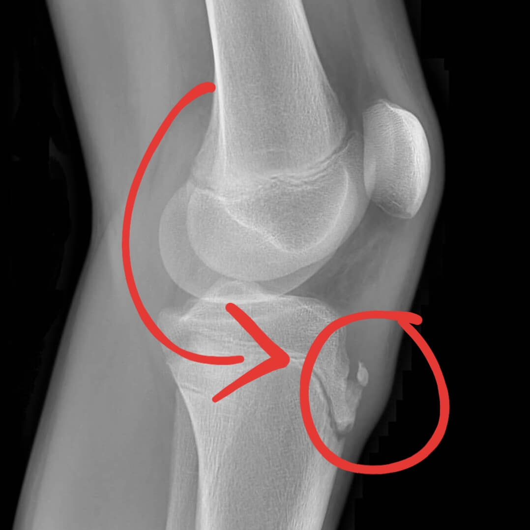 Osgood Schlatter Disease in Adults: Treatment for Knee Pain