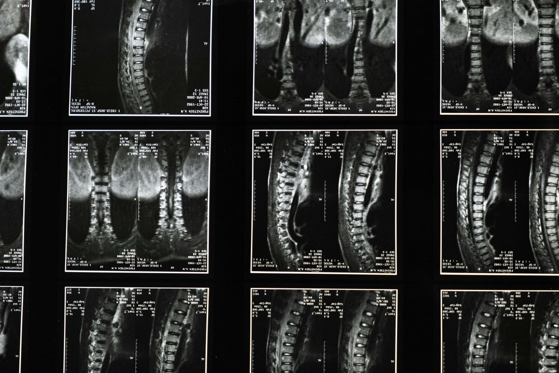 Research Shows Spinal Degeneration May Be There Whether You Have Back Pain or Not