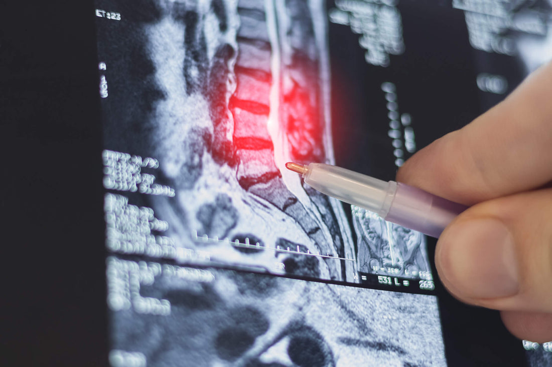 Disc Bulge Healing: New Research Reveals Which Discs Heal Best