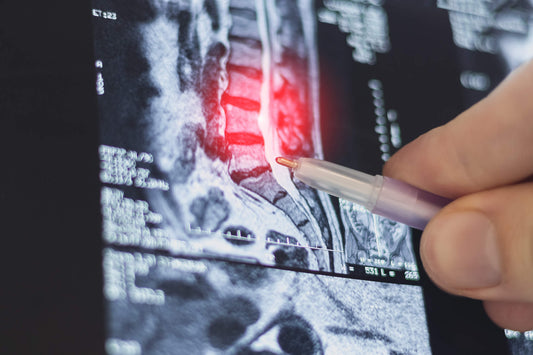 Disc Bulge Healing: New Research Reveals Which Discs Heal Best