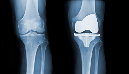 How Long Does a Knee Replacement Last?