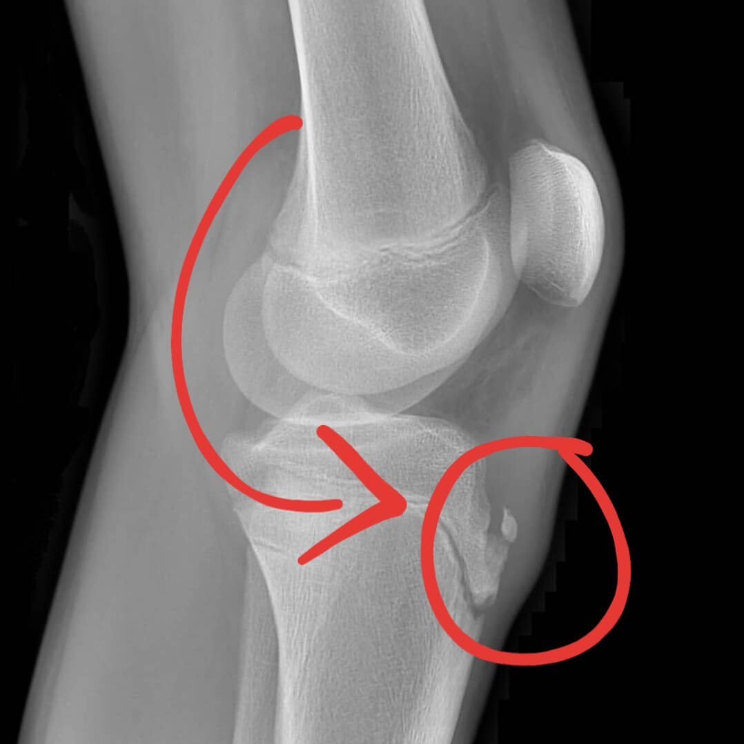 osgood schlatter disease xray